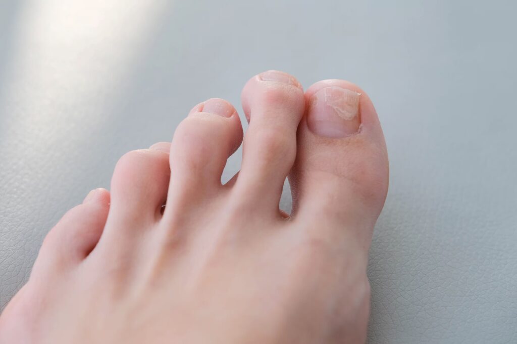 Fungal Nail Infections converted
