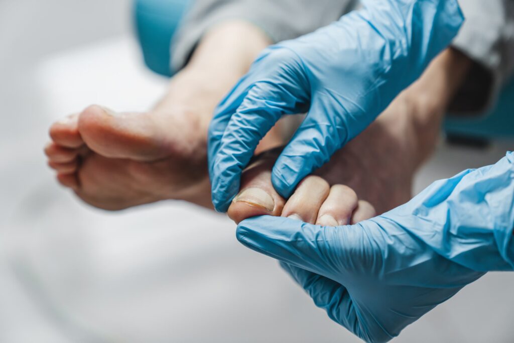 Fungal Nail Treatment converted 1