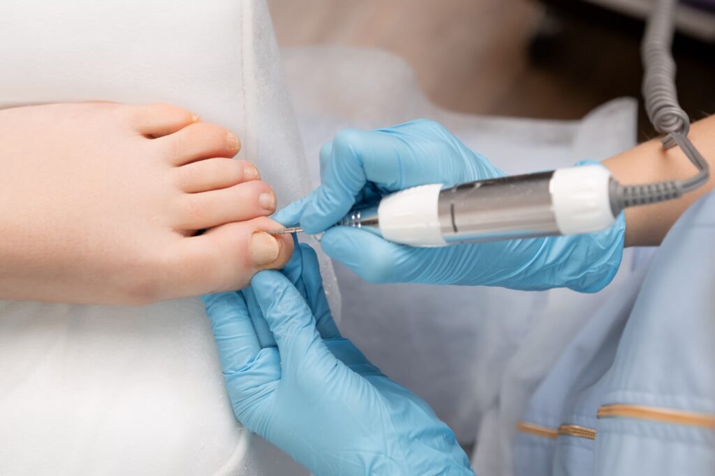Fungal Nail Treatment converted