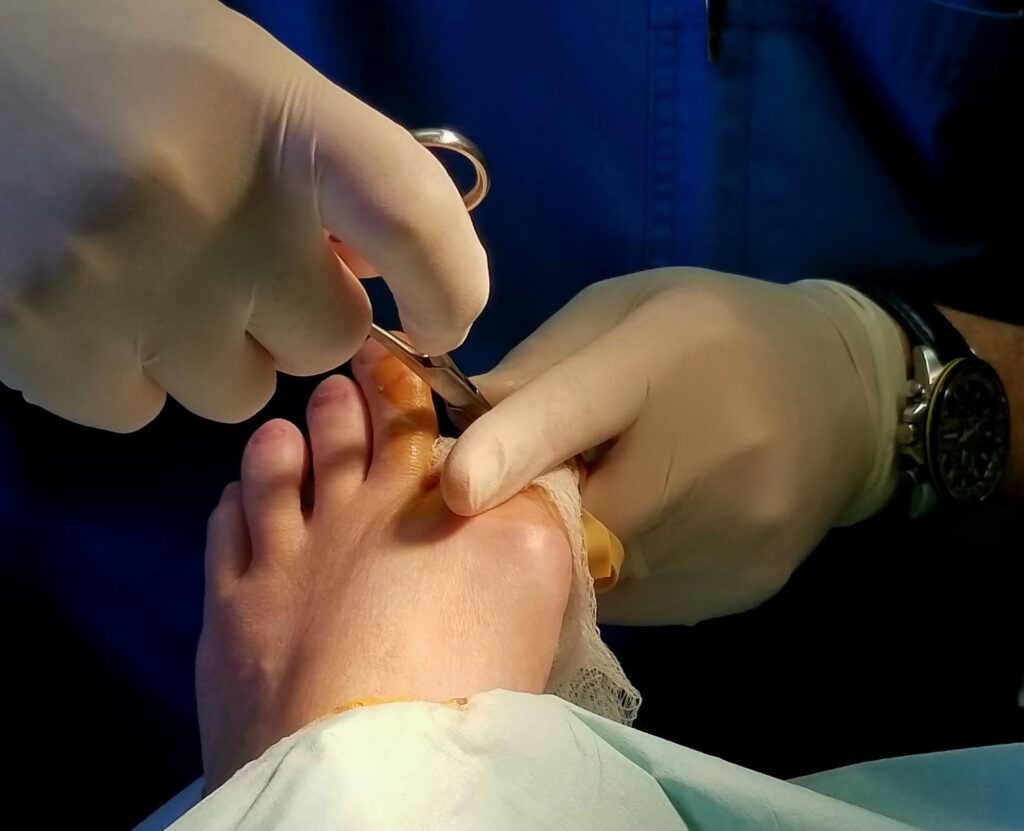 Nail Surgery converted 1