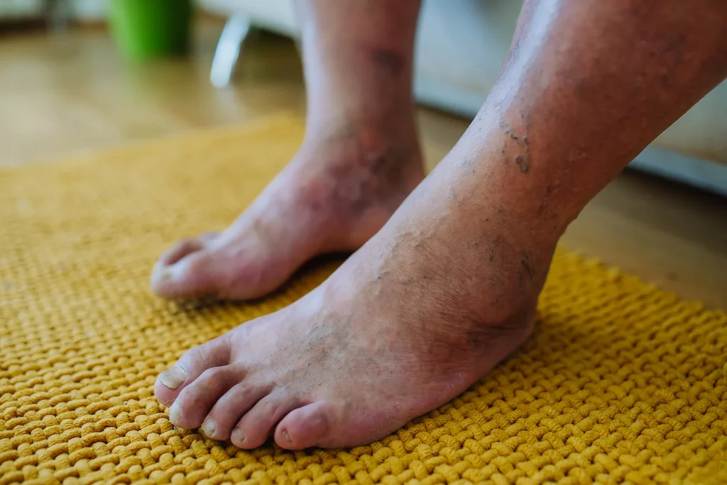 a close up shot of man s feet with diabetic foot
