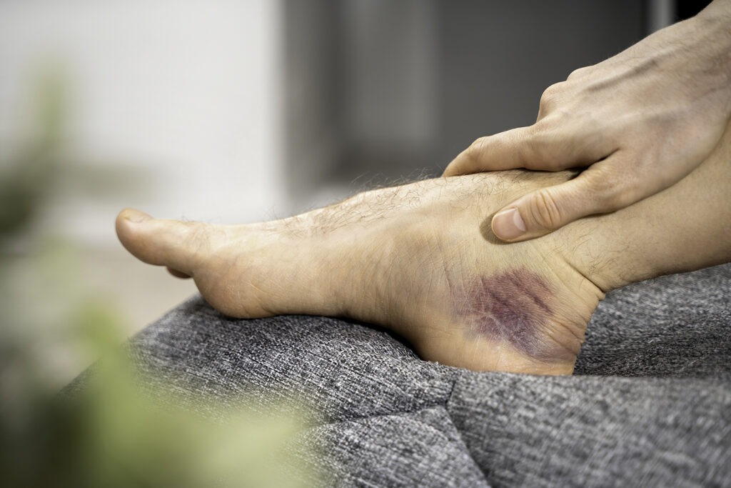 close up bruised male ankle with deep blue purple