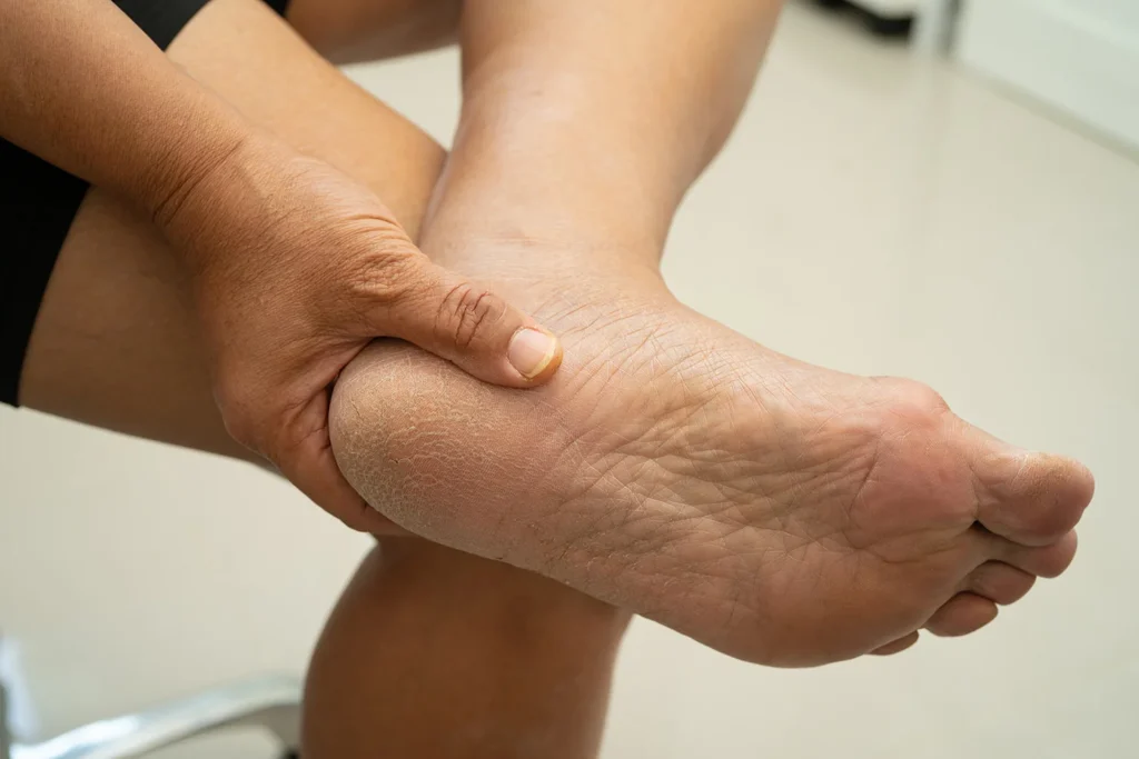 close up of cracked skin on heel