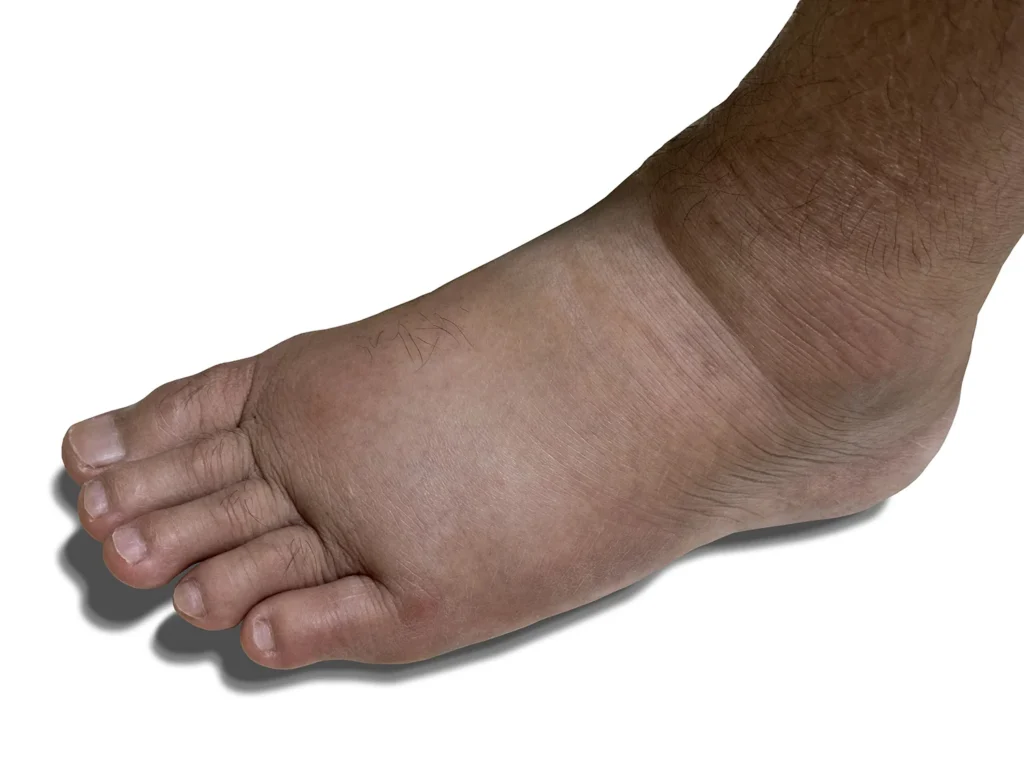 close up swollen left foot as a result of ankle