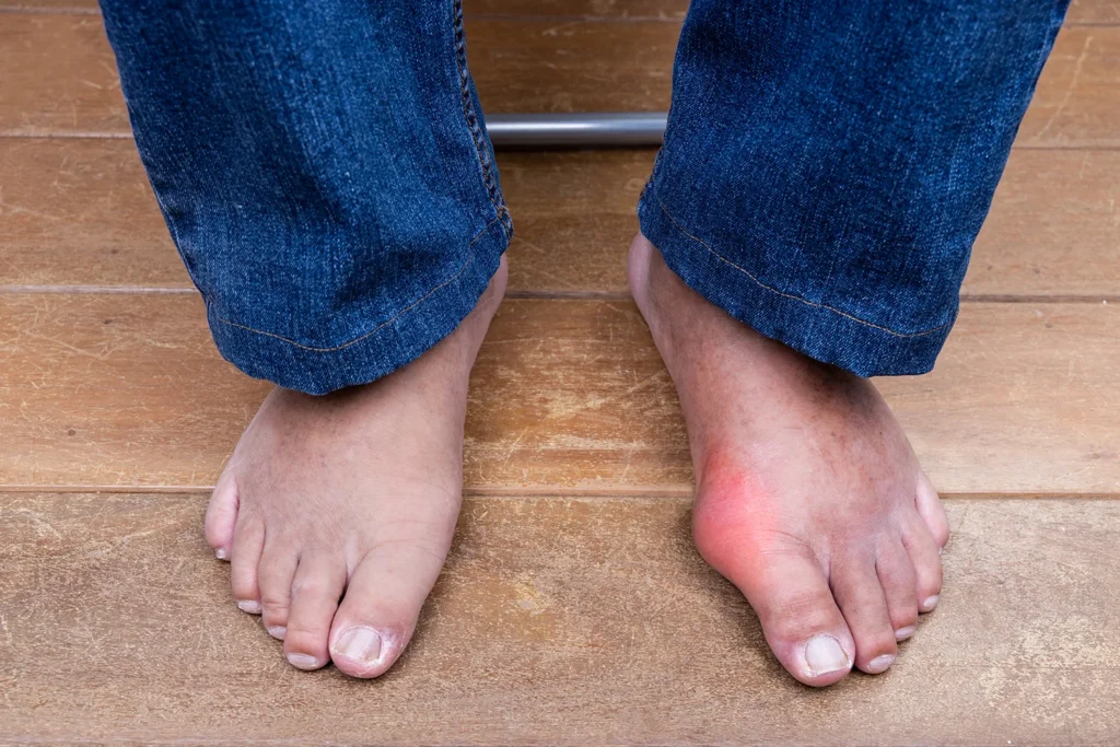 foot with bunion red